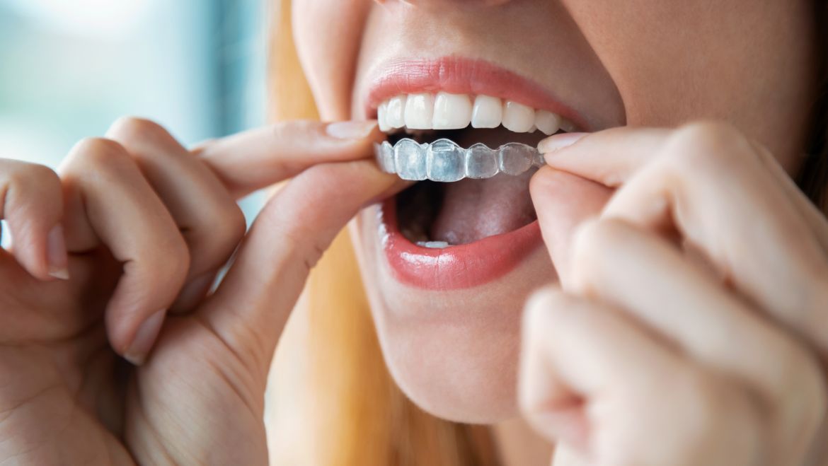 ¿La ortodoncia invisible es apta para todo el mundo?