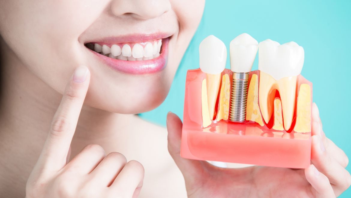 Implantes dentales: ¿Qué tipos existen?