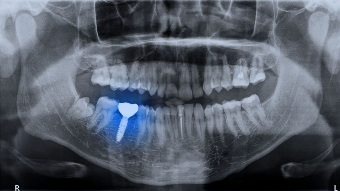 ¿Por qué los implantes dentales son necesarios?