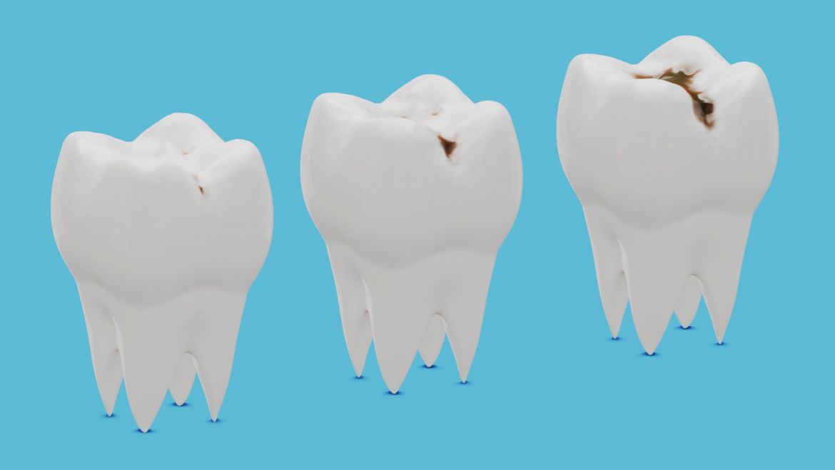 ¿Cuáles son las posibles causas de la caries?