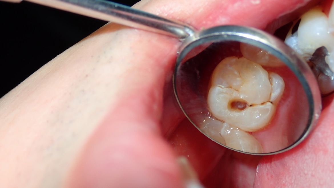 6 falsos mitos sobre la caries