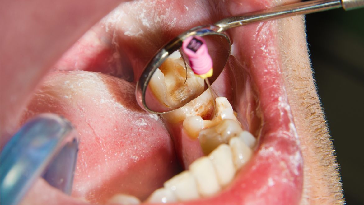 ¿Qué es una endodoncia y por qué es tan importante?
