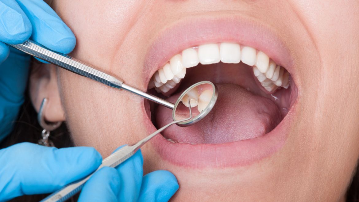 ¿Qué es la restauración dental?