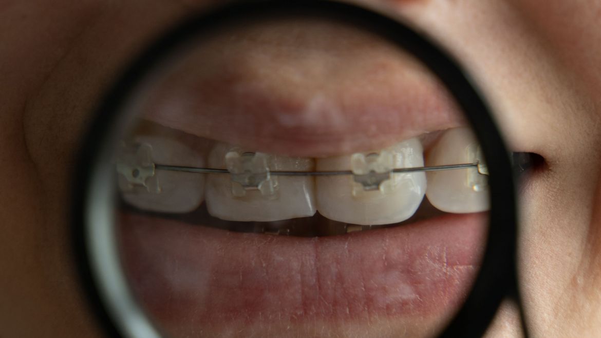 ¿De qué depende la duración de un tratamiento de ortodoncia?