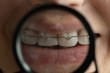 ¿De qué depende la duración de un tratamiento de ortodoncia?