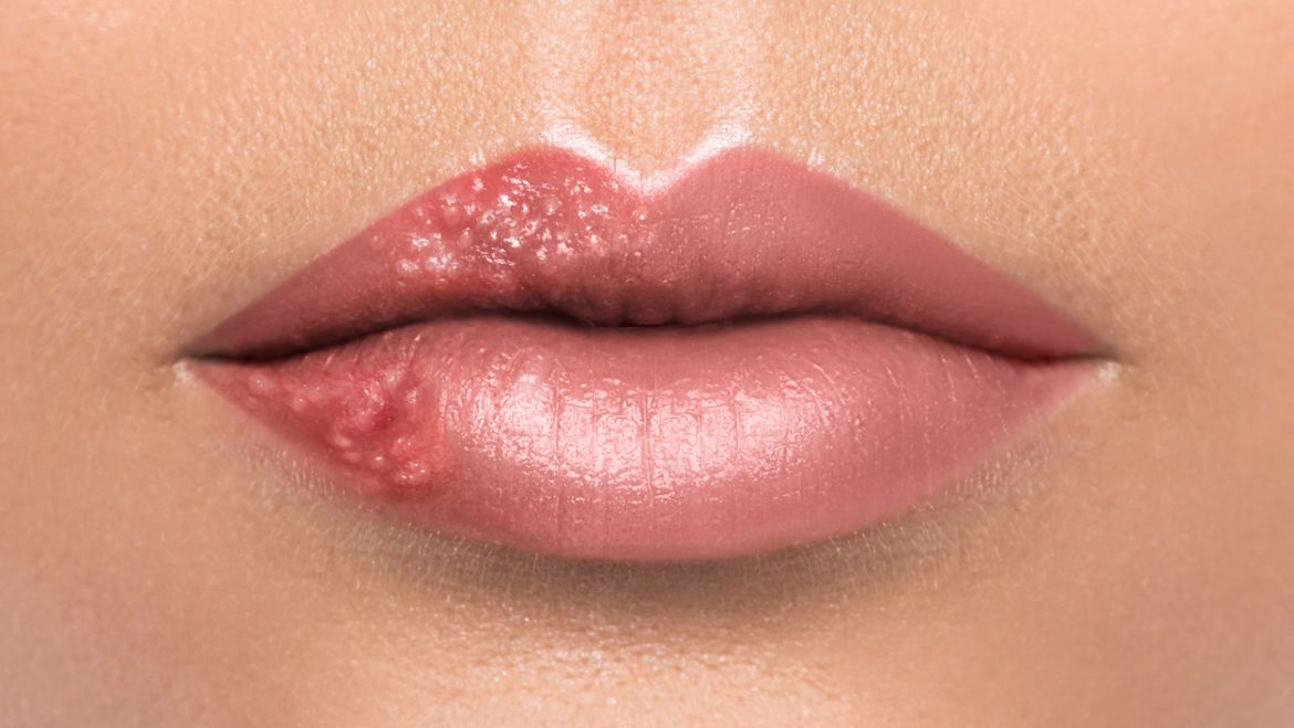 ¿Qué es un herpes labial?