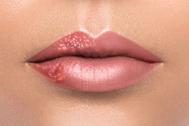 ¿Qué es un herpes labial?