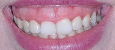 Gingivectomía: ¿qué es?