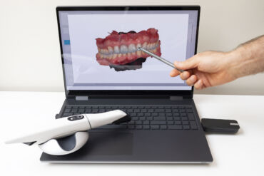 Uso de escáner intraoral para planificar tratamientos de implantes