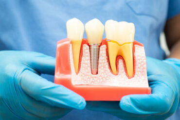 Implantes y cirugía maxilofacial: coordinación multidisciplinar