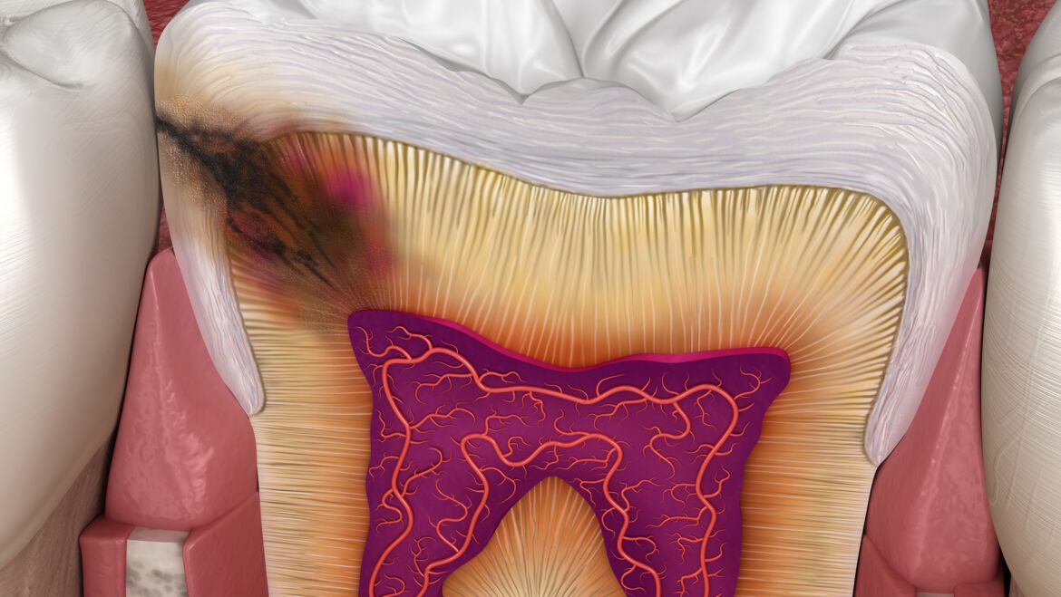 Caries interproximales: el peligro que se esconde entre tus dientes