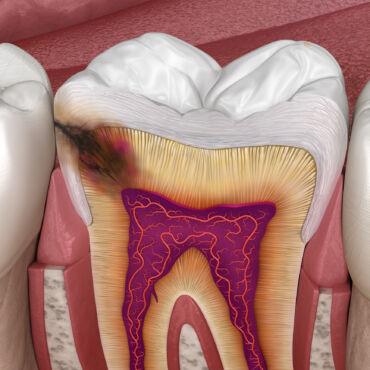 Caries interproximales: el peligro que se esconde entre tus dientes